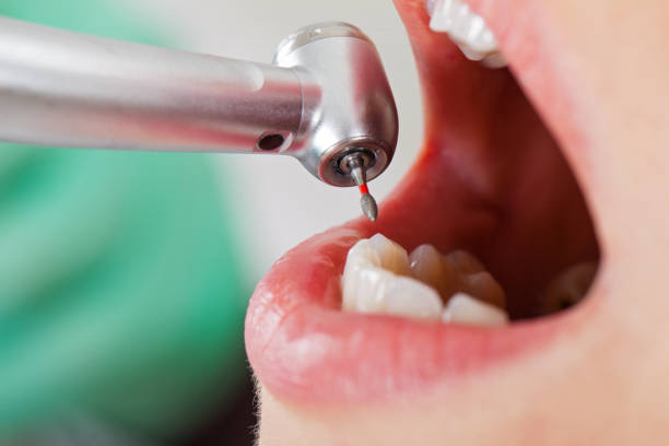 Best Broken or Cracked Tooth Emergency Dentist in Monte Sereno, CA